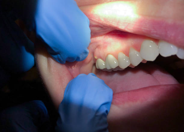 Best Emergency Broken Tooth Repair in Bonneauville, PA